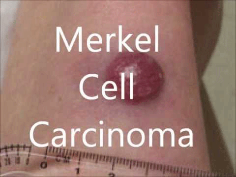 text-Merkel-cell-carcinoma