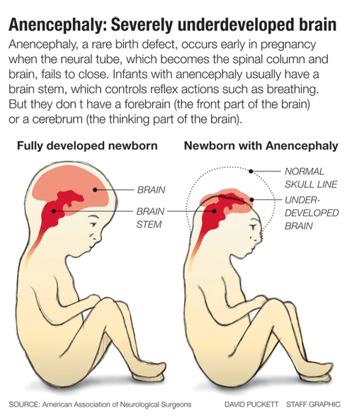 anencephaly